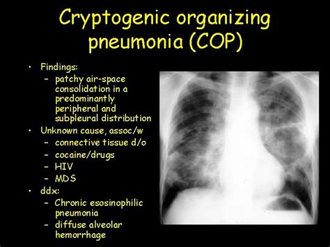 cryptogeen|Cryptogenic organizing pneumonia